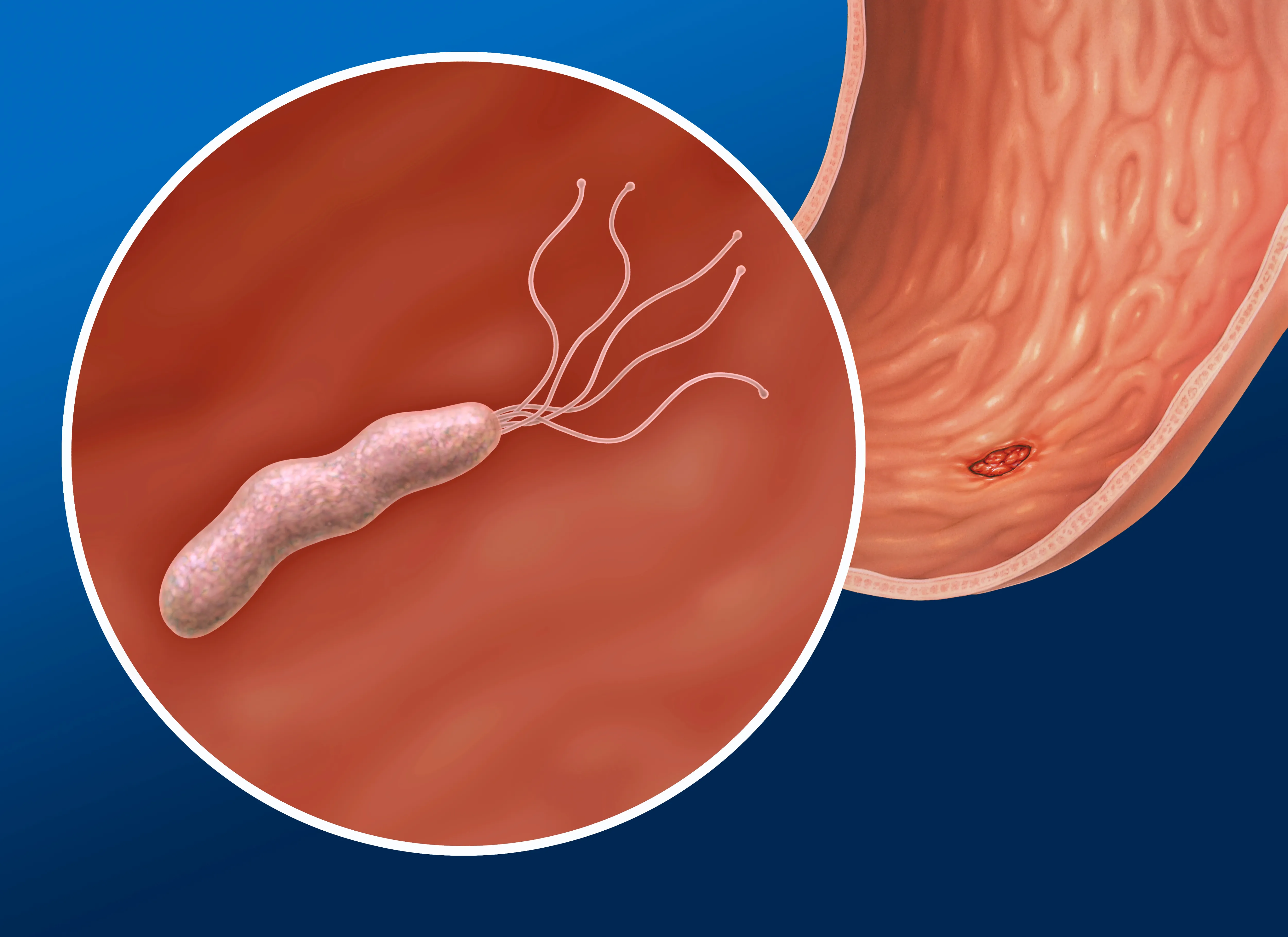ピロリ菌検査・除菌